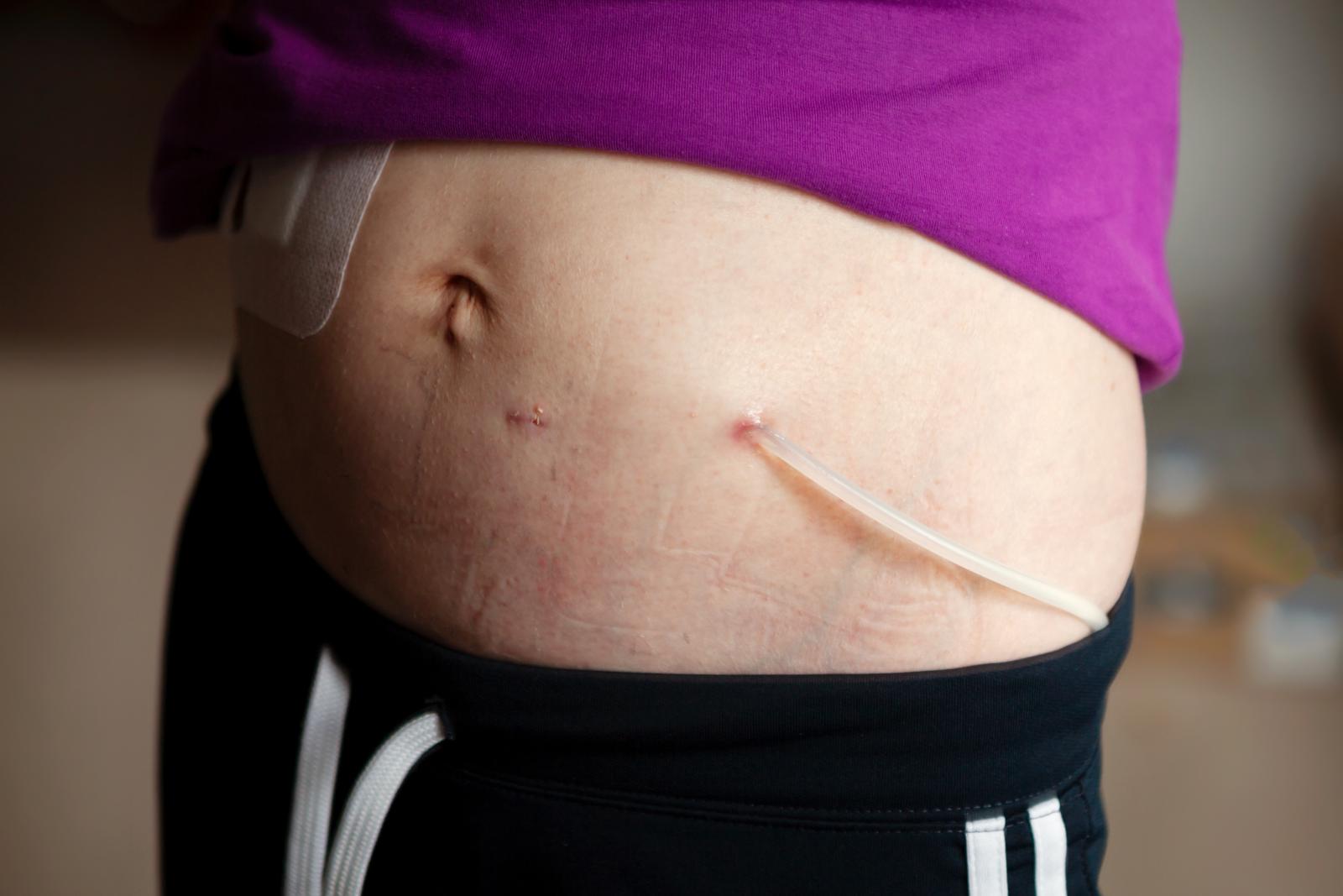 Treatment Choices for Kidney Failure SaskHealthAuthority