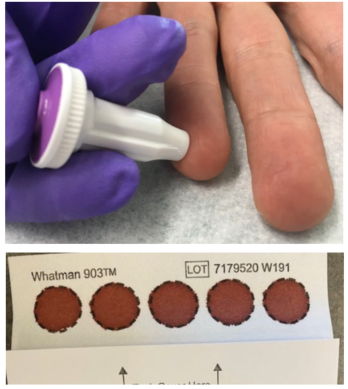 Needle pricking a finger for STBBI testing and dried blood spot test sample.